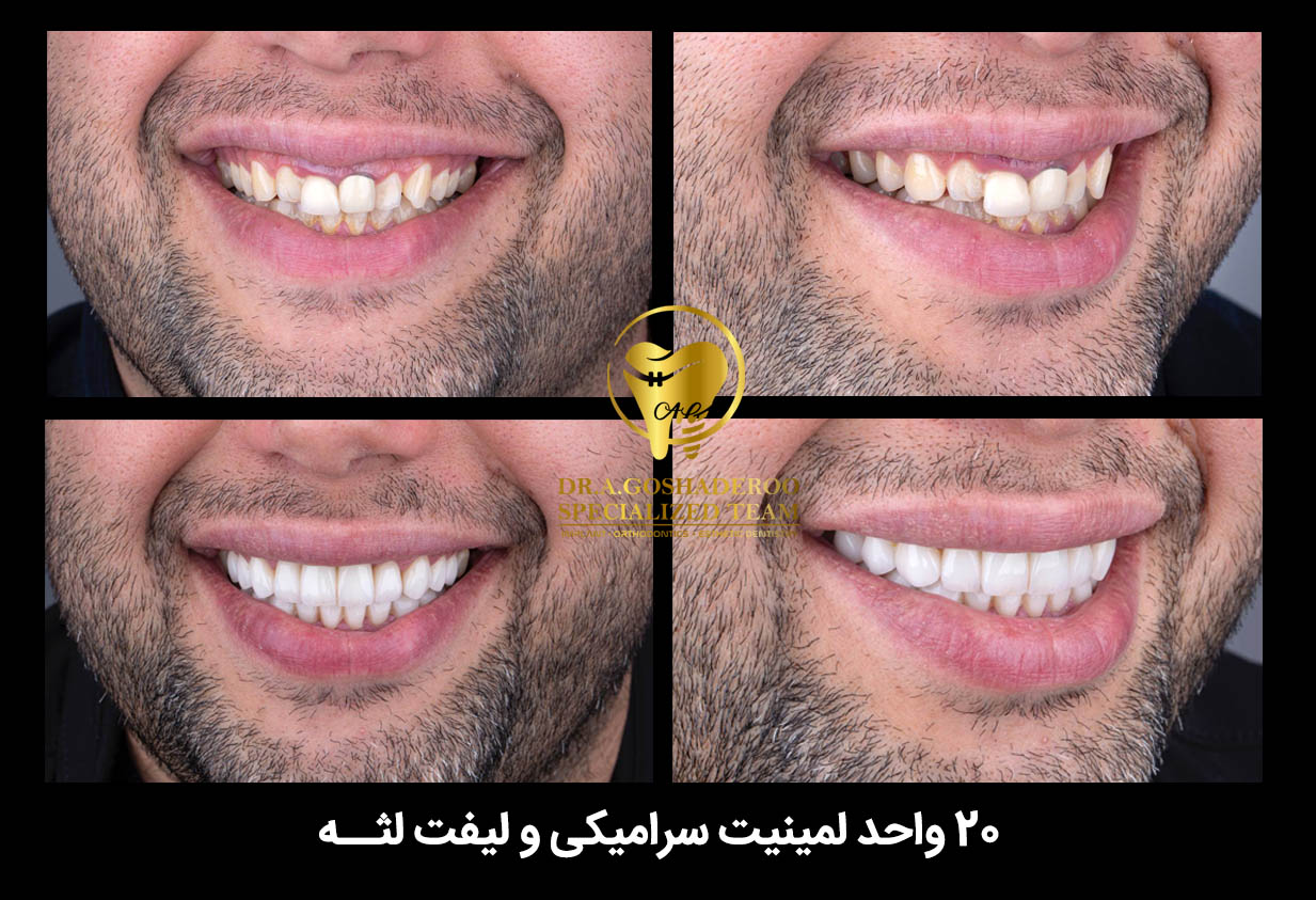 لمینیت سرامیکی و لیفت لثه _ دندان‌پزشک زیبایی