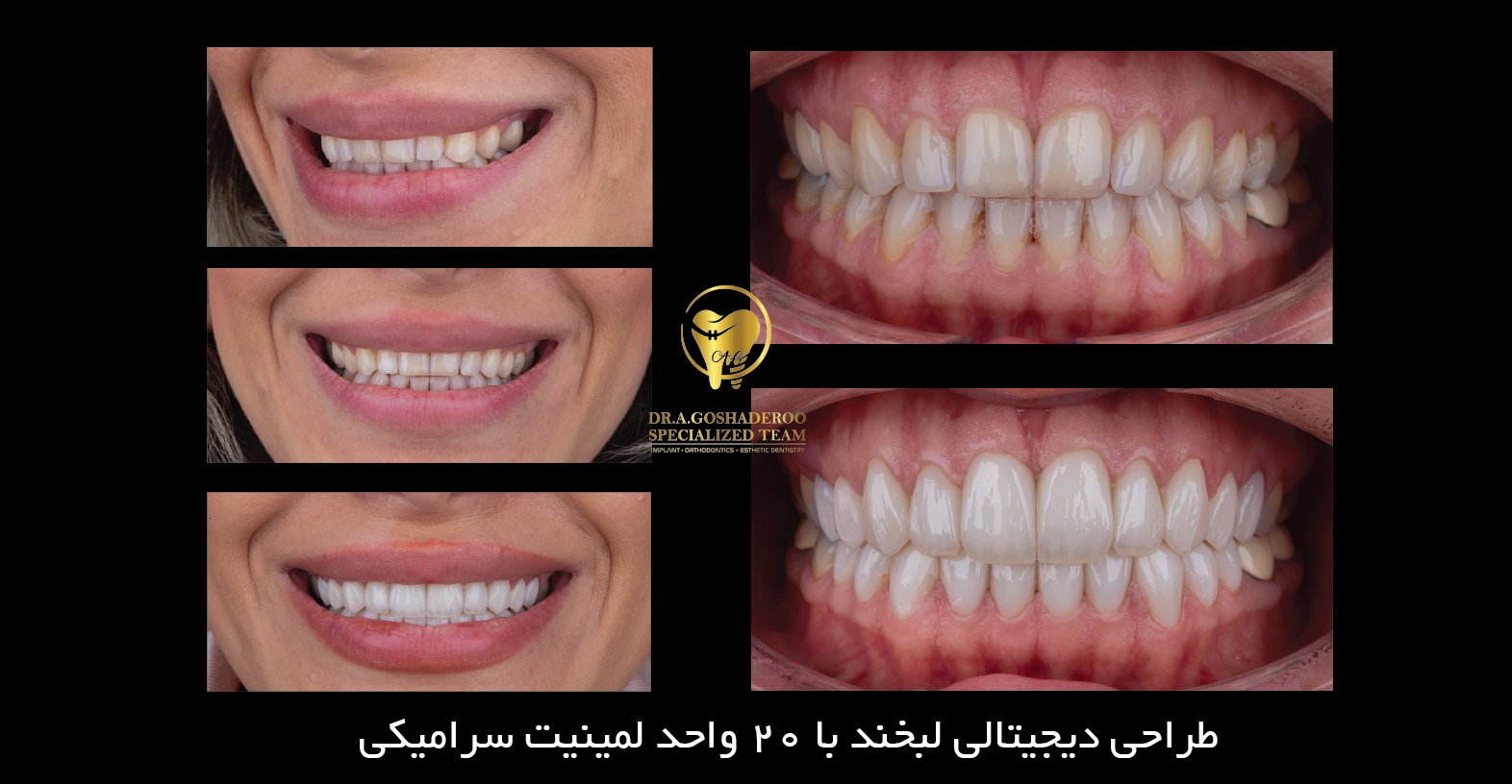 دندان‌پزشک زیبایی _ طراحی دیجیتالی لبخند