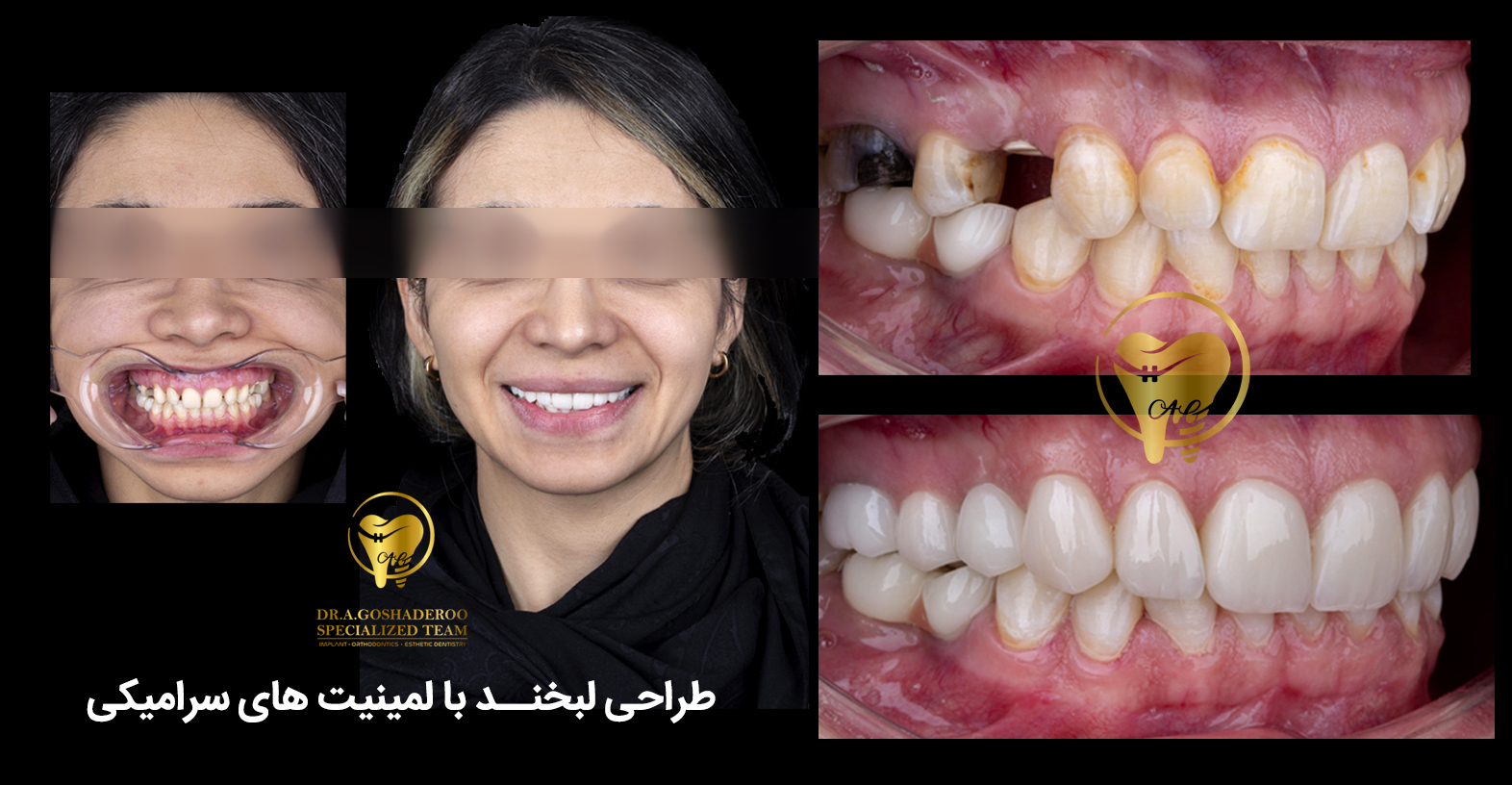 دندان‌پزشک زیبایی _ طراحی لبخند با لمینیت سرامیکی