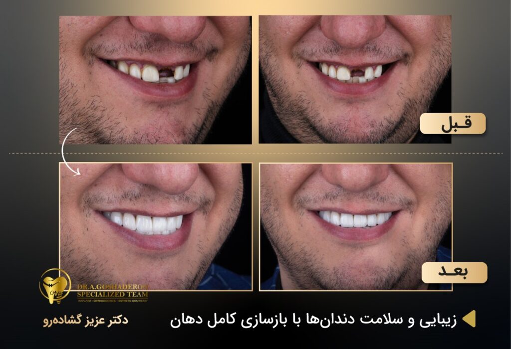 ایمپلنتهای دندانی