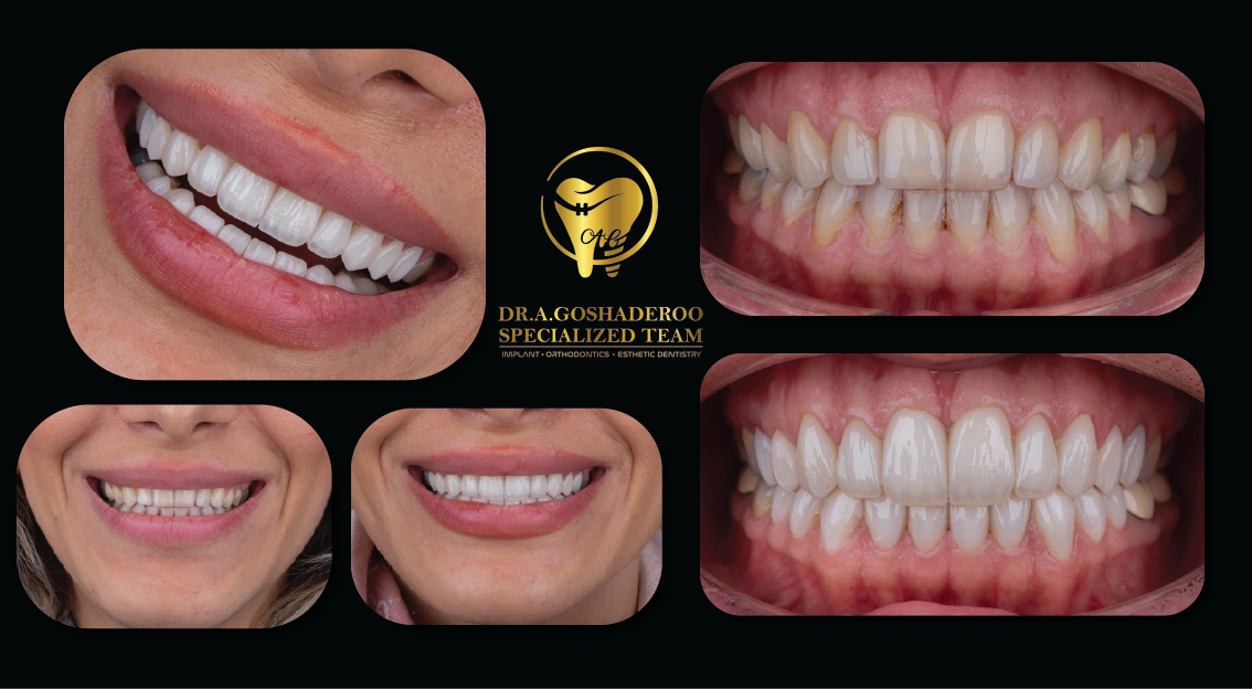 بازسازی کامل دندانها