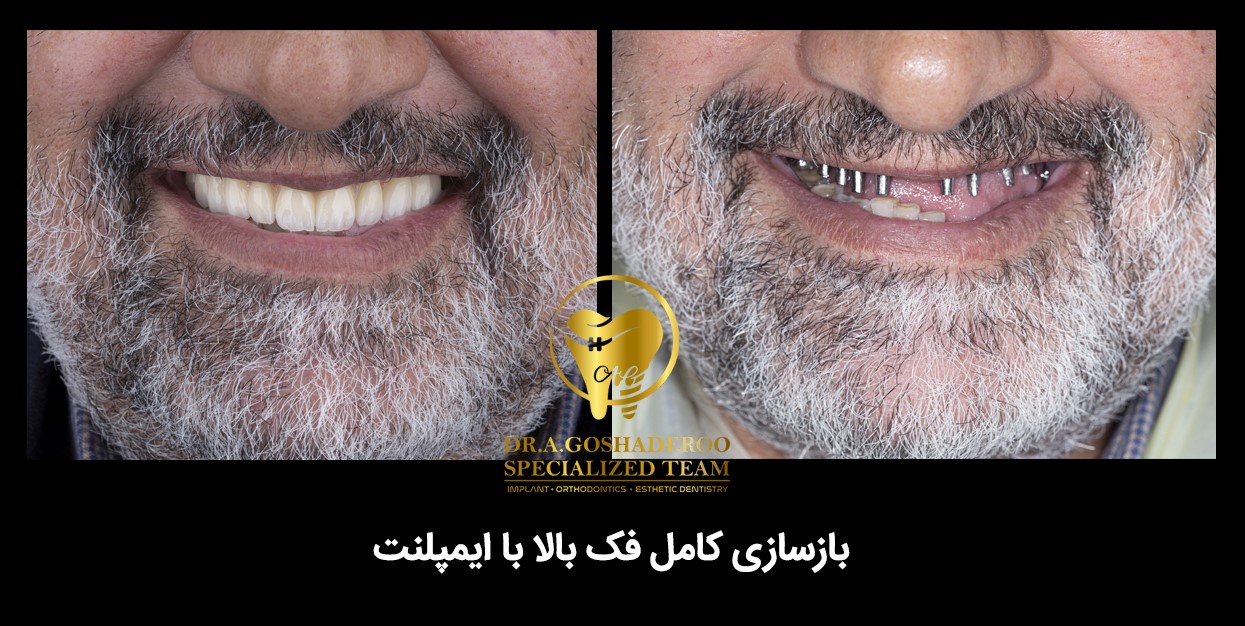 بازسازی کامل دندانها