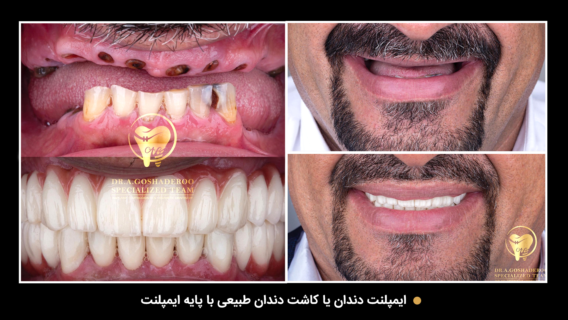 ایمپلنت دندان در تهران