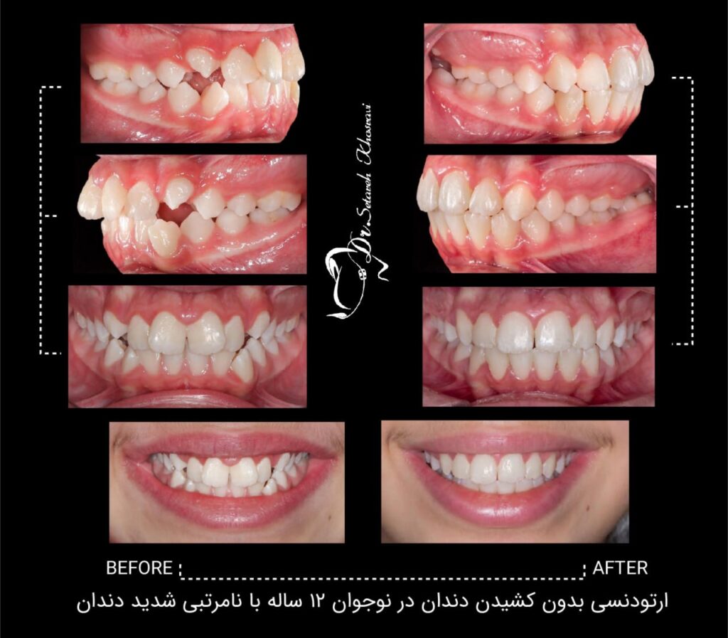 ارتودنسی بدون کشیدن دندان