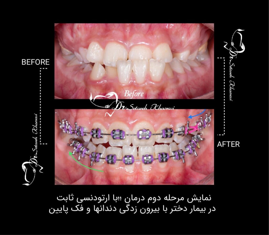 ارتودنسی ثابت