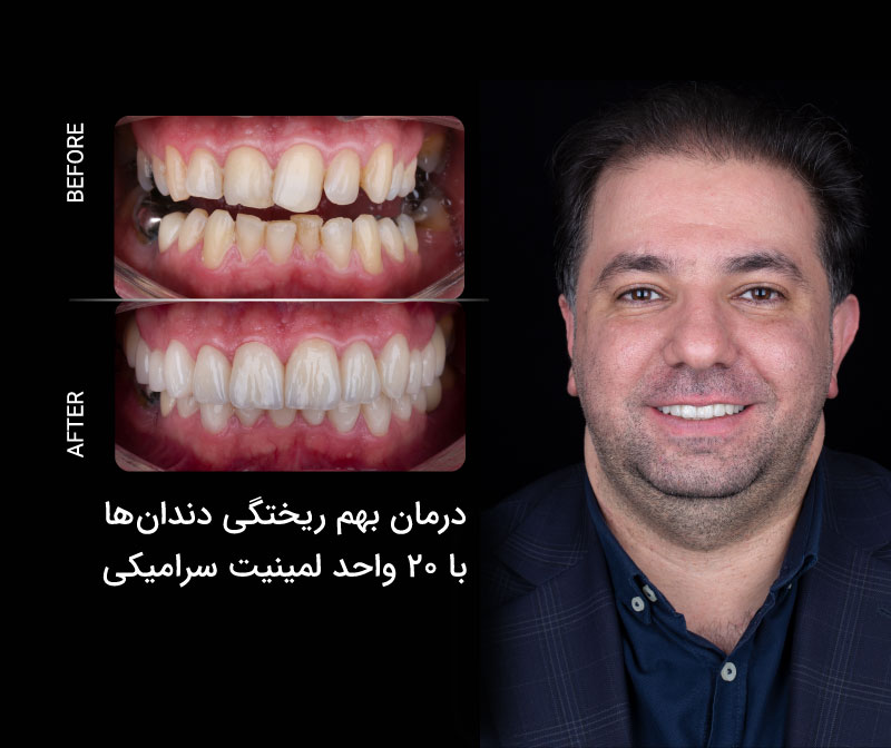 لمینیت سرامیکی