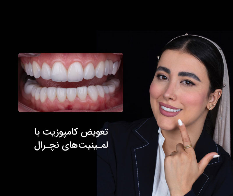 لمینیت دندان