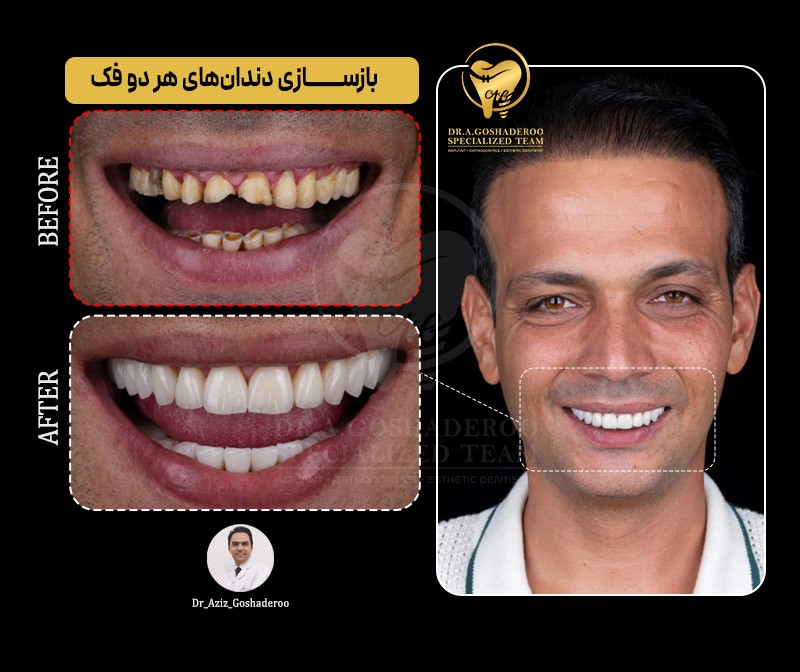 تصویربرداری CBCT قبل از ایمپلنت