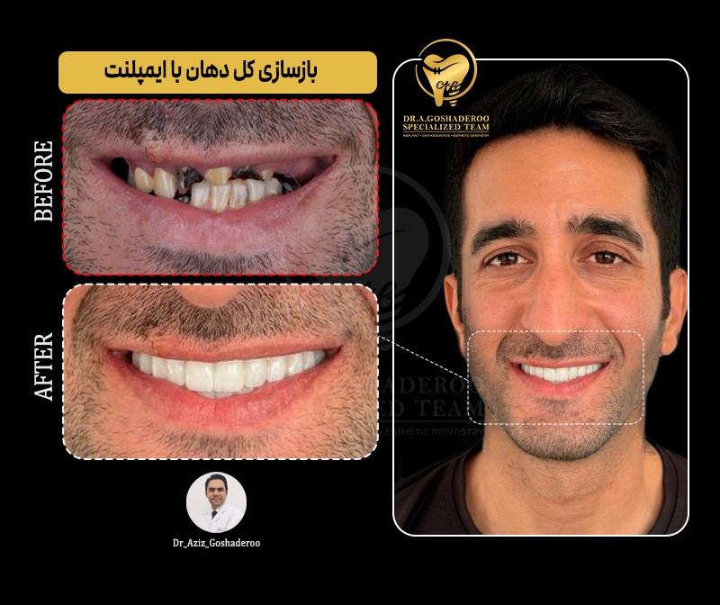 بازسازی استخوان فک قبل از کاشت ایمپلنت
