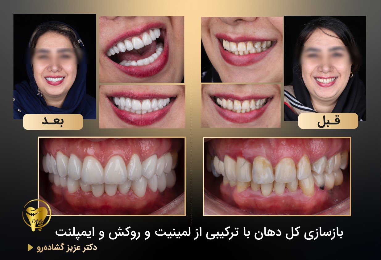 مراحل انجام ایمپلنت دندان