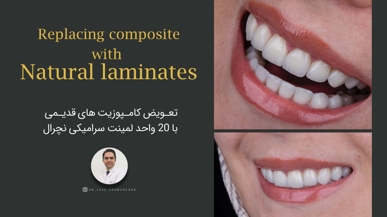 تعویض کامپوزیت های قدیمی با ۲۰ واحد لمینت سرامیکی نچرال