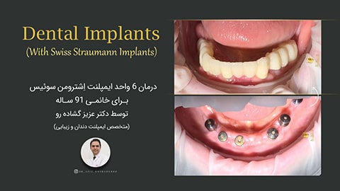 درمان 6 واحد ایمپلنت اشترومن سوئیس برای خانمی 91 ساله