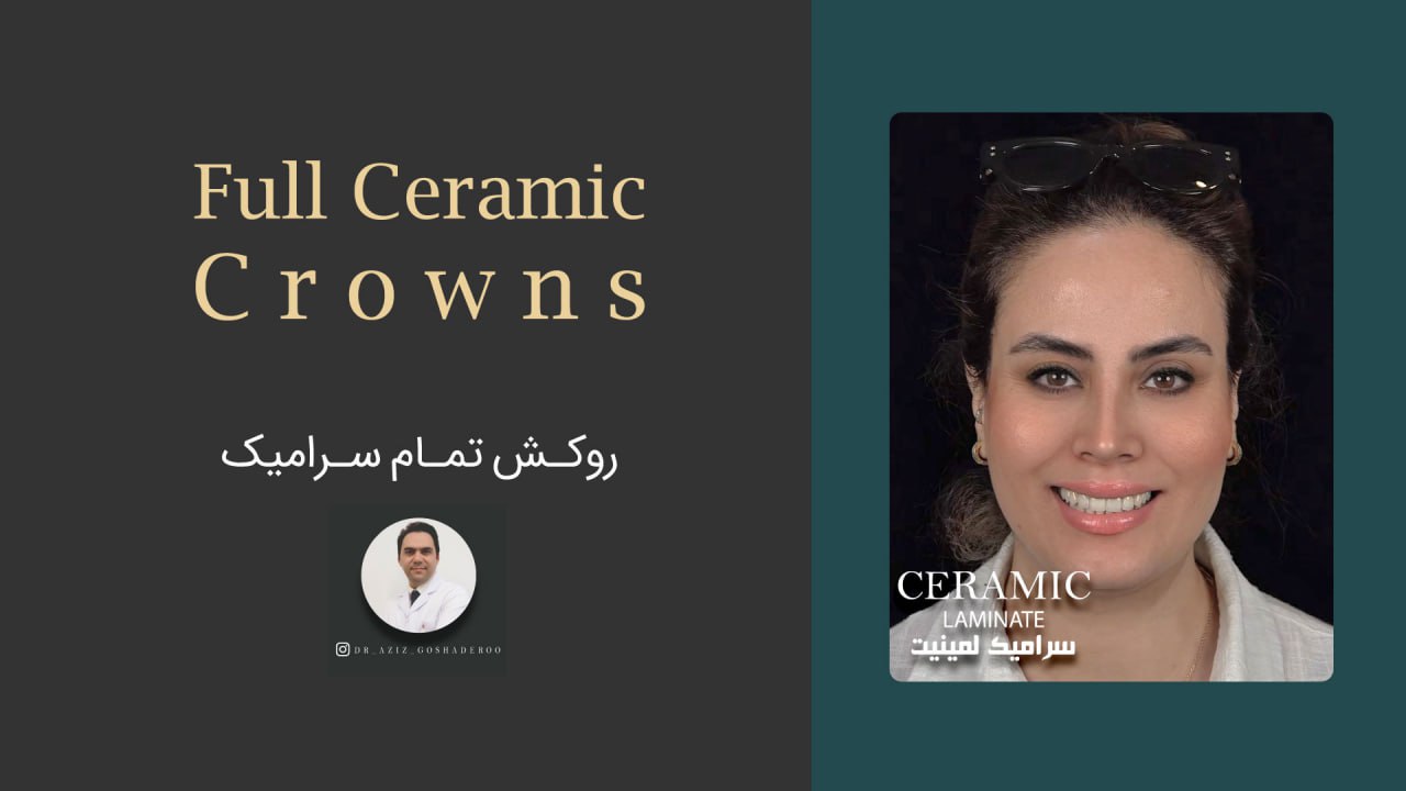 روکش تمام سرامیک