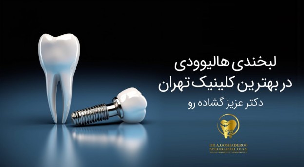 قبل از ایمپلنت دندان چه نکاتی را باید بدانیم ؟