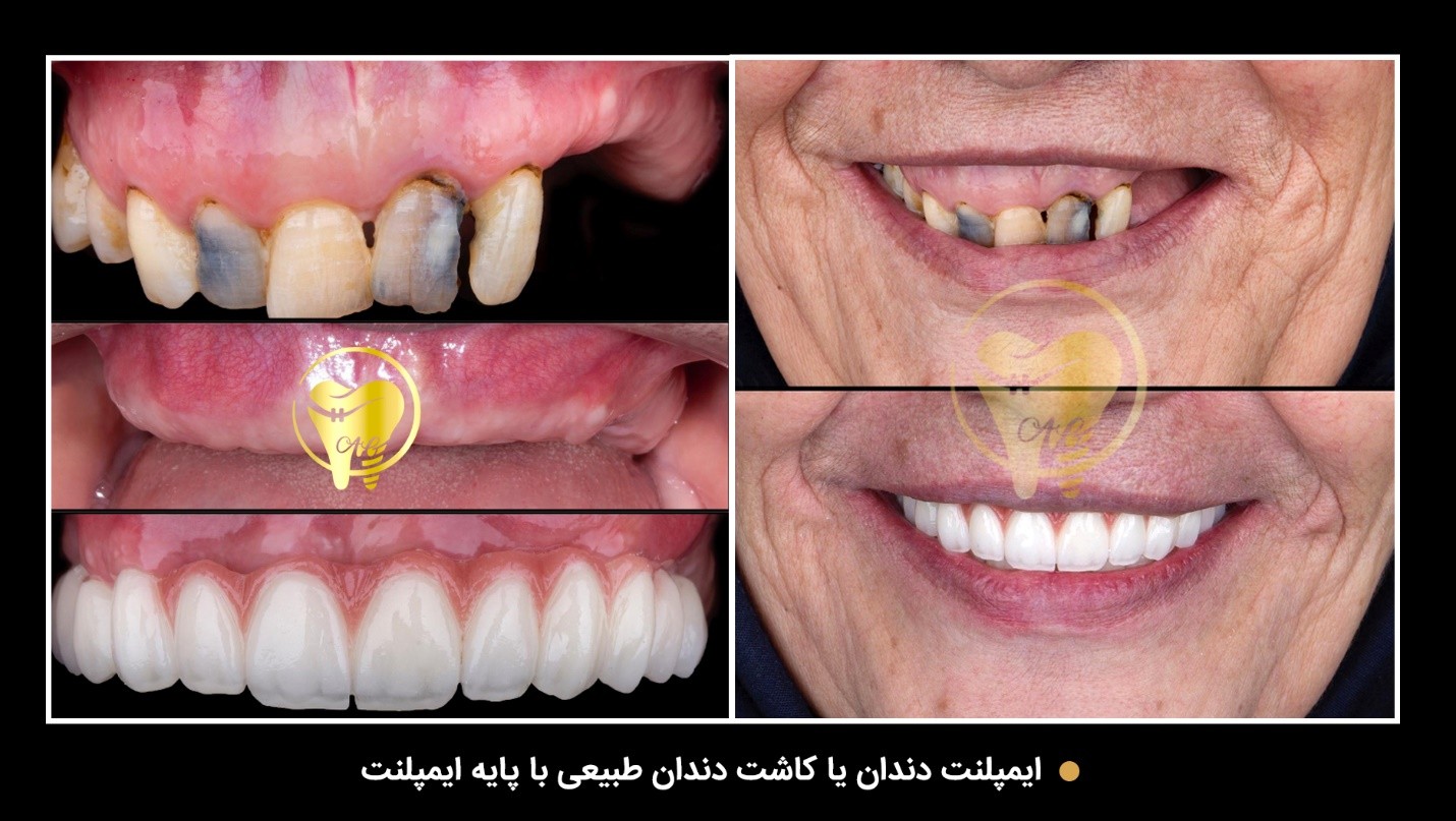 عکس نمونه درمان ایمپلنت در کلینیک دکتر گشاده رو