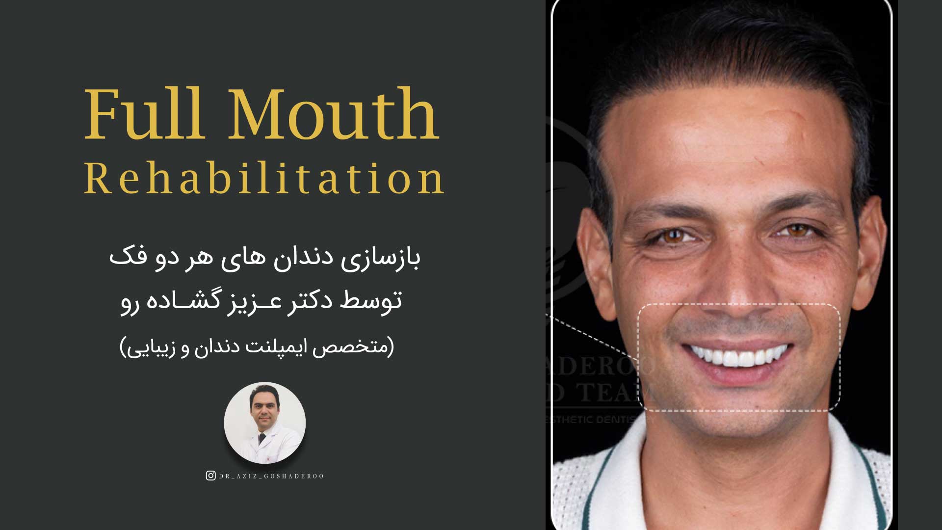 بازسازی کامل دندان‌های هر دو فک؛ مراحل و نمونه واقعی