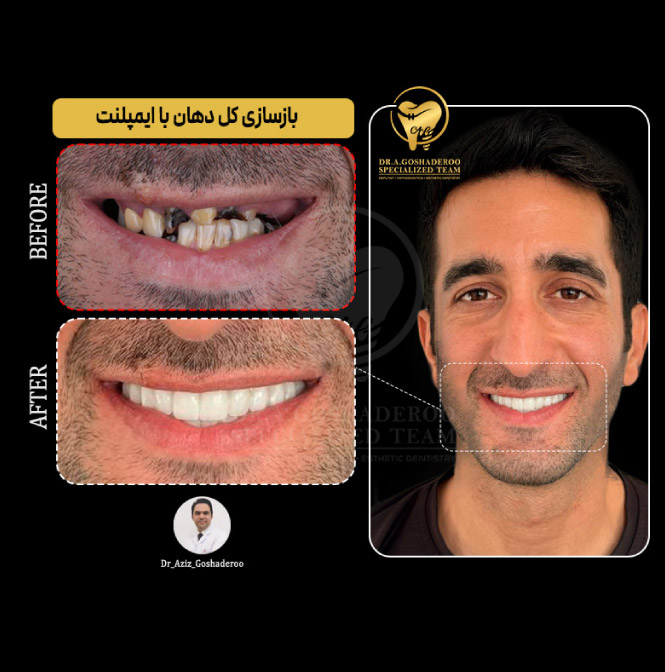 بازسازی کل دهان با ایمپلنت و روکش های سرامیکی به روش کاملا دیجیتال
