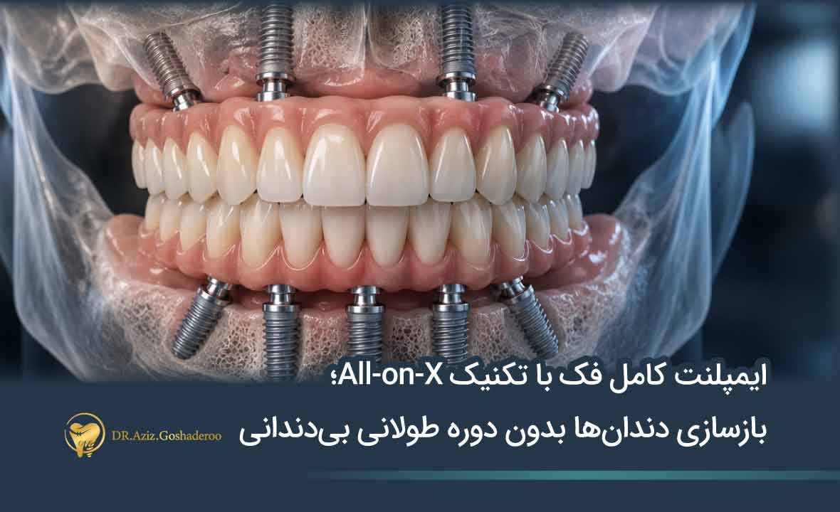 ایمپلنت کامل فک با All-on-X؛ بدون دوره طولانی بی‌دندانی