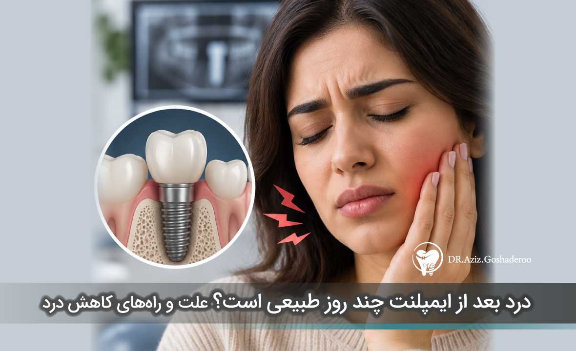 درد بعد از ایمپلنت چند روز طبیعی است؟ علت و راه‌های کاهش درد