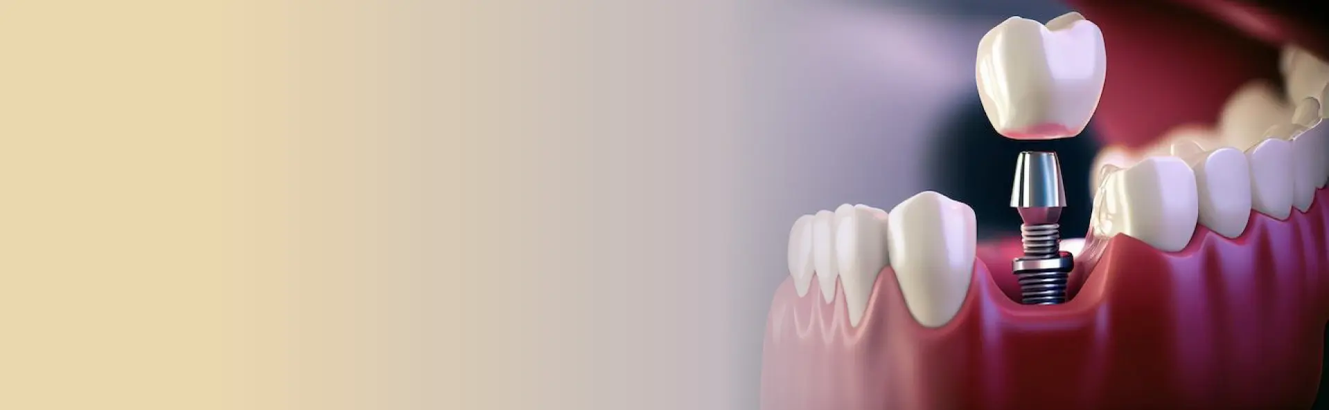 ایمپلنت دندان در تهران