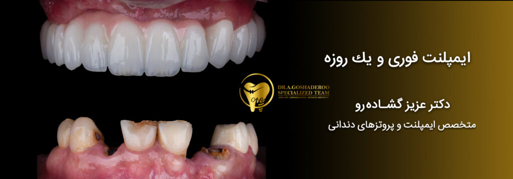 معجزه ایمپلنت