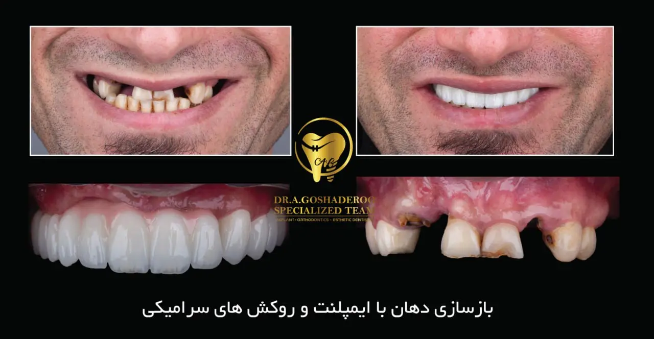 ایمپلنت فوری دندان برای چه افرادی مناسب است؟