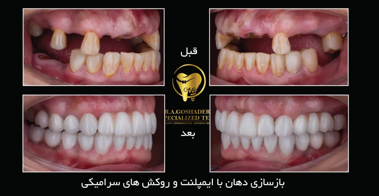آیا ایمپلنت فوری دندان درد دارد؟