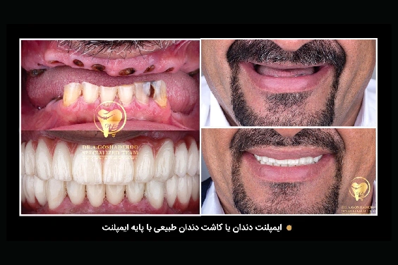 مزایای ایمپلنت دیجیتال