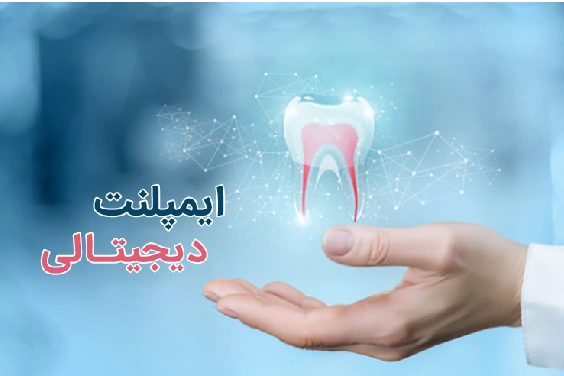 مراحل انجام ایمپلنت دیجیتال