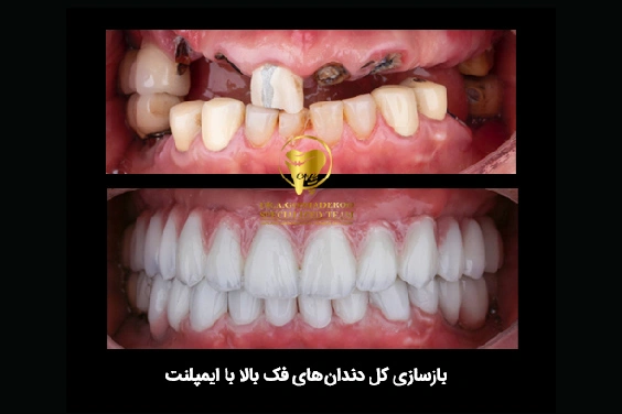 چه کسانی کاندید مناسب ایمپلنت دیجیتال هستند؟