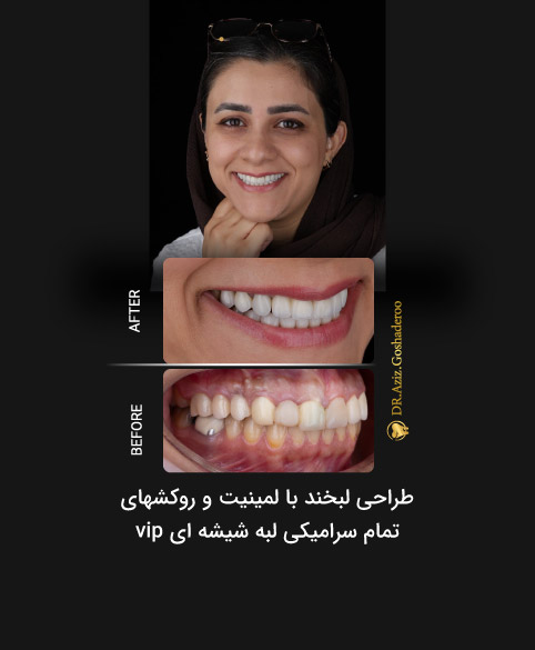 پاسخ به مهم‌ترین سؤالات بیماران درباره لمینت دندان