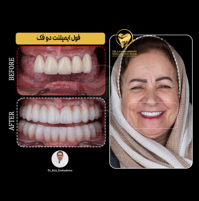 ایمپلنت فوری _ ایمپلنت یک روزه