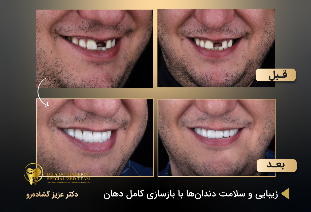 ایمپلنت دیجیتال چگونه انجام می‌شود؟