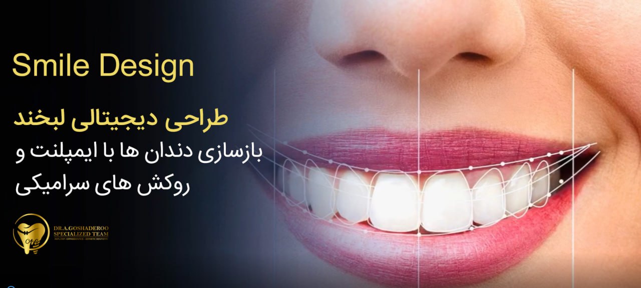 تفاوت ایمپلنت دیجیتال با ایمپلنت معمولی