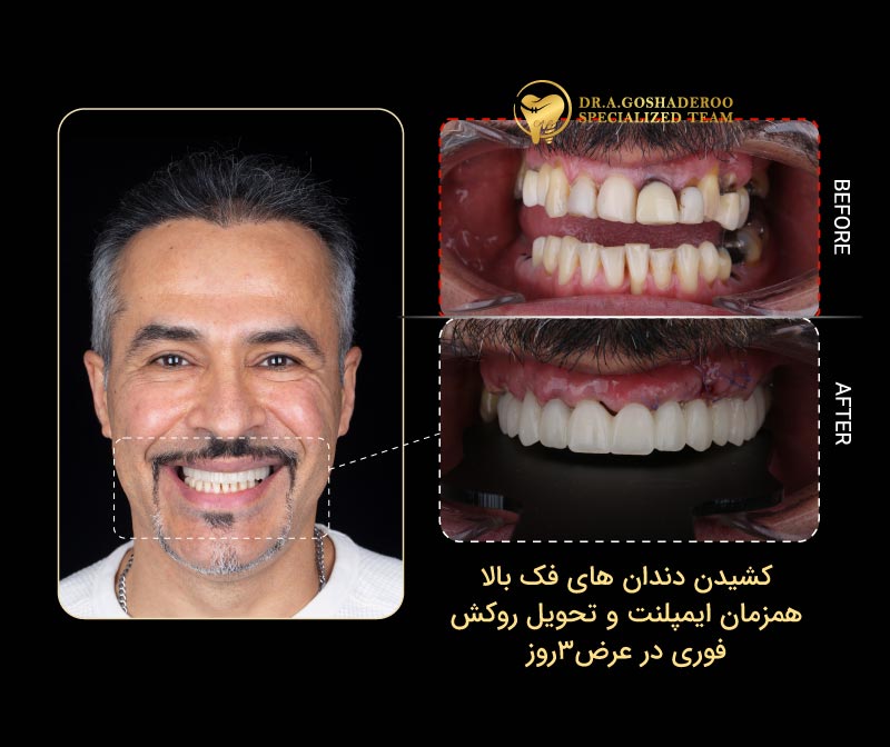 بازسازی کامل فک با All-on-X؛ یکی از درمان‌های شاخص دکتر عزیز گشاده‌رو