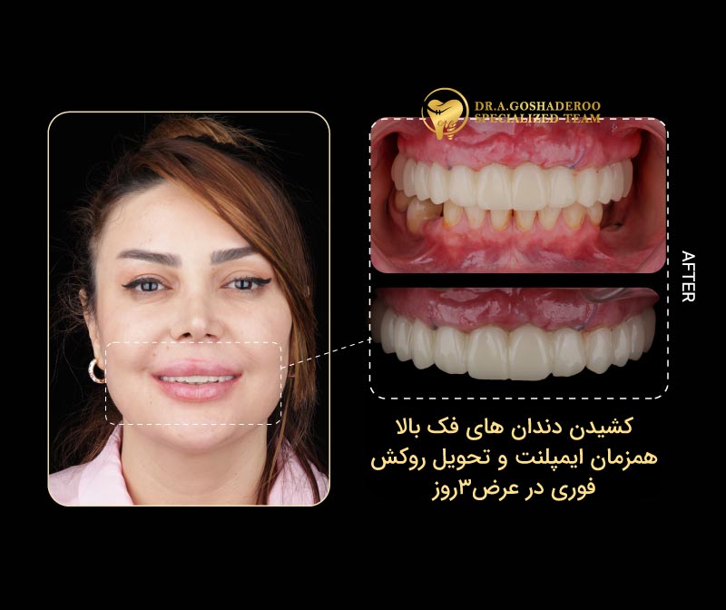 تفاوت All-on-X و All-on-4 چیست؟