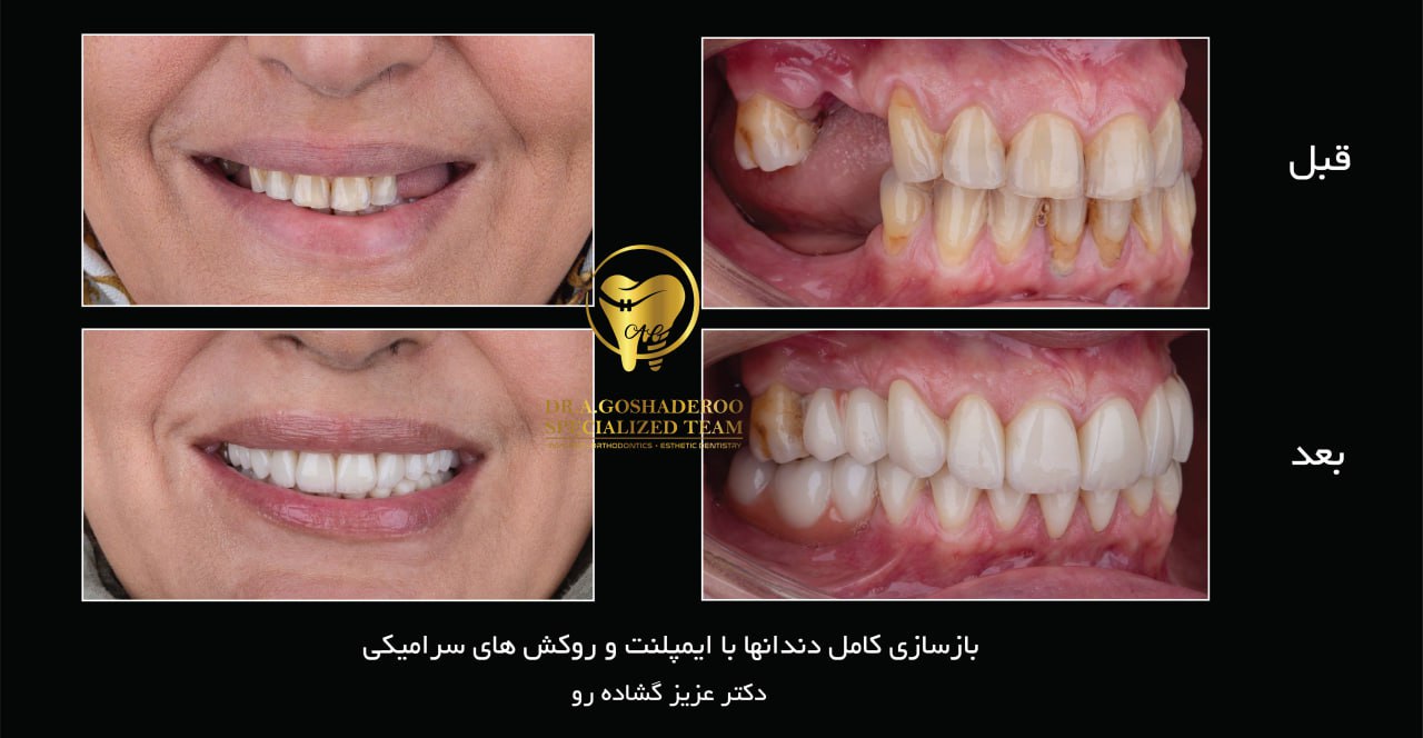 بازسازی کامل دندانها با ایمپلنت و روکش های سرامیکی