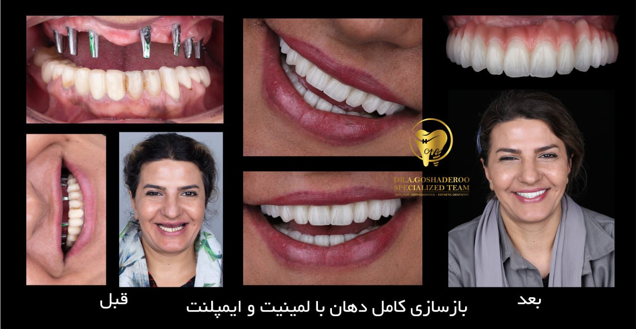 بازسازی کامل دهان با لمینیت و ایمپلنت