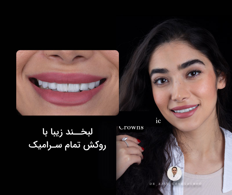 لبخند زیبا با روکش تمام سرامیک