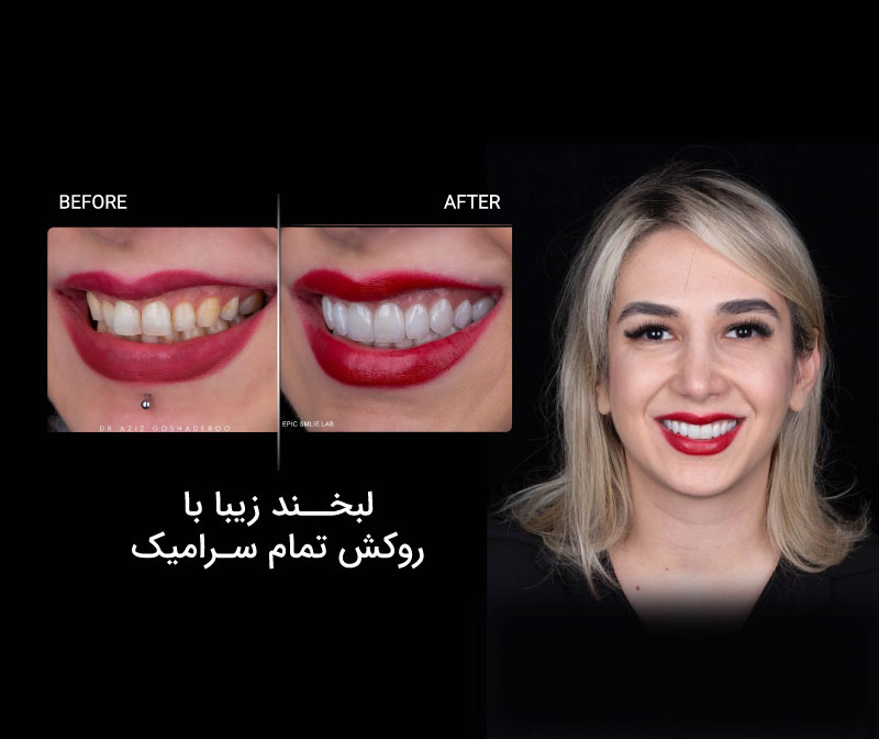 بازسازی کامل دهان با ایمپلنت و روکشهای سرامیکی