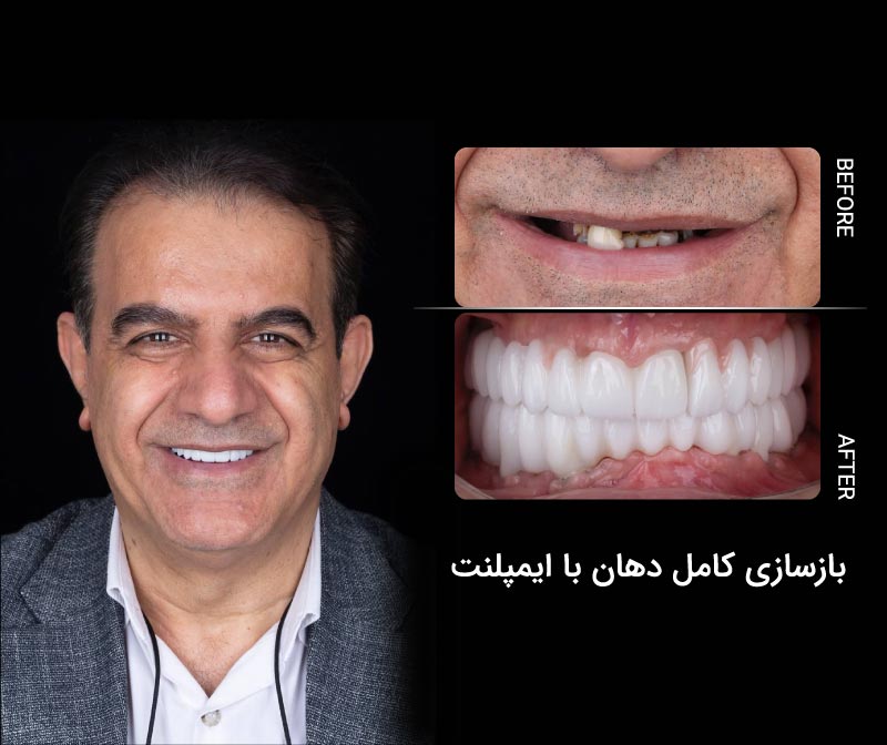 بازسازی کامل دهان با ایمپلنت