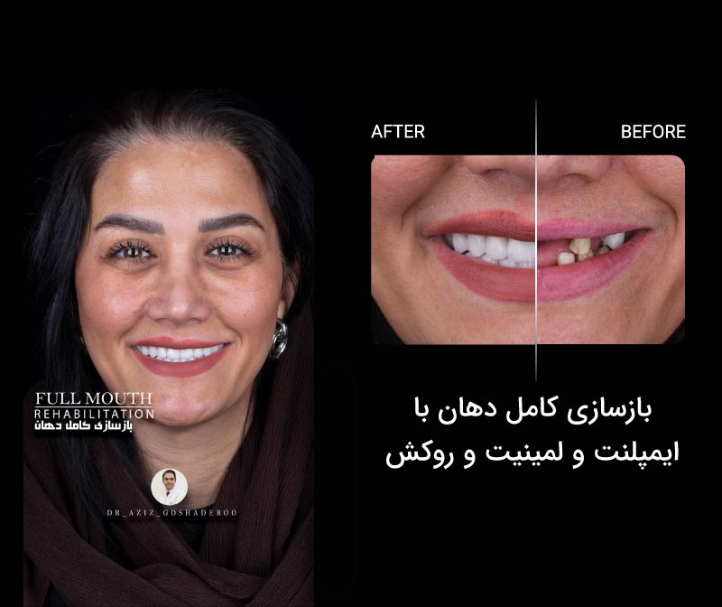 بازسازی کامل دهان با ایمپلنت و لمینیت و روکش
