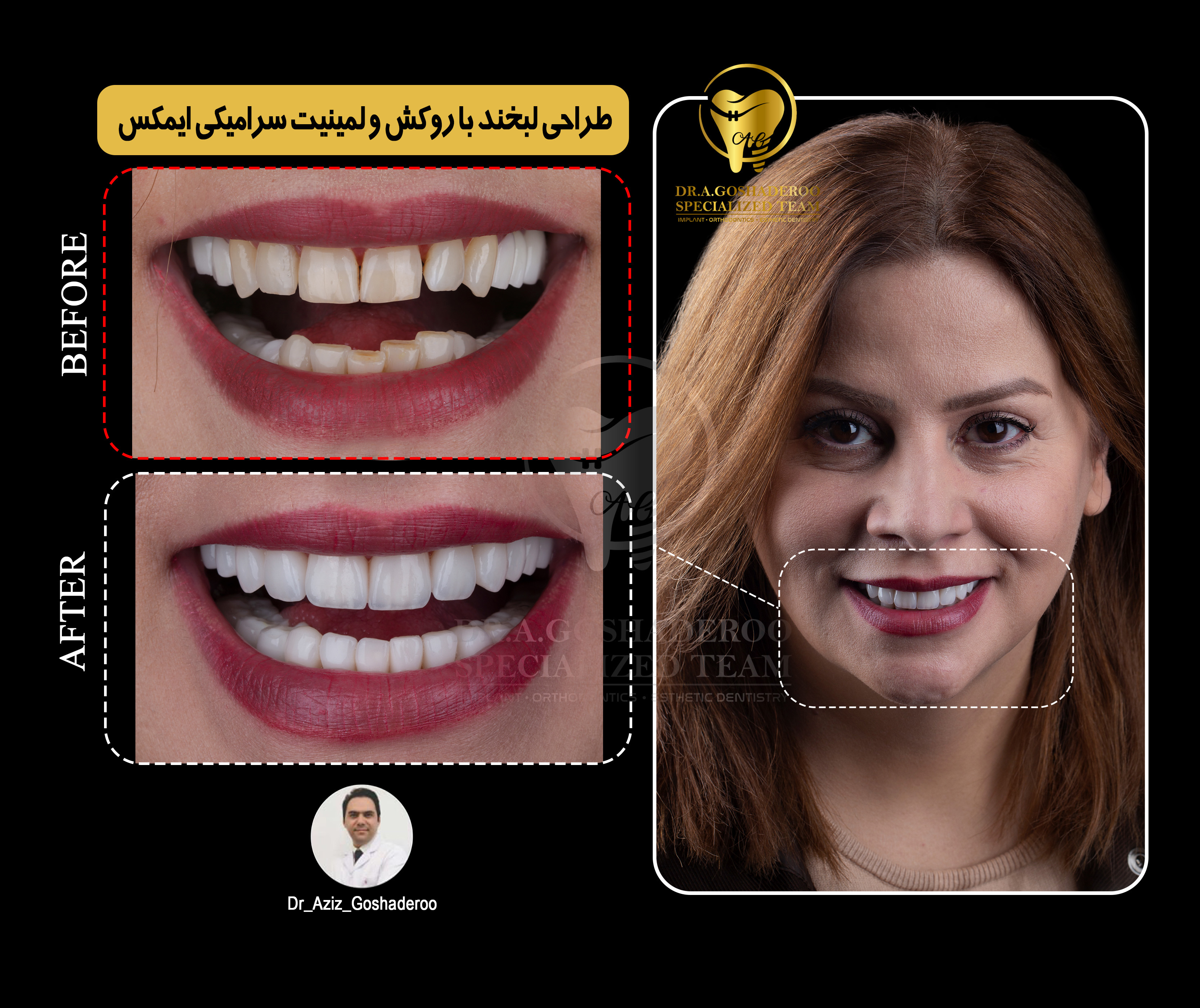 طراحی لبخند با روکش و لمینیت سرامیکی ایمکس