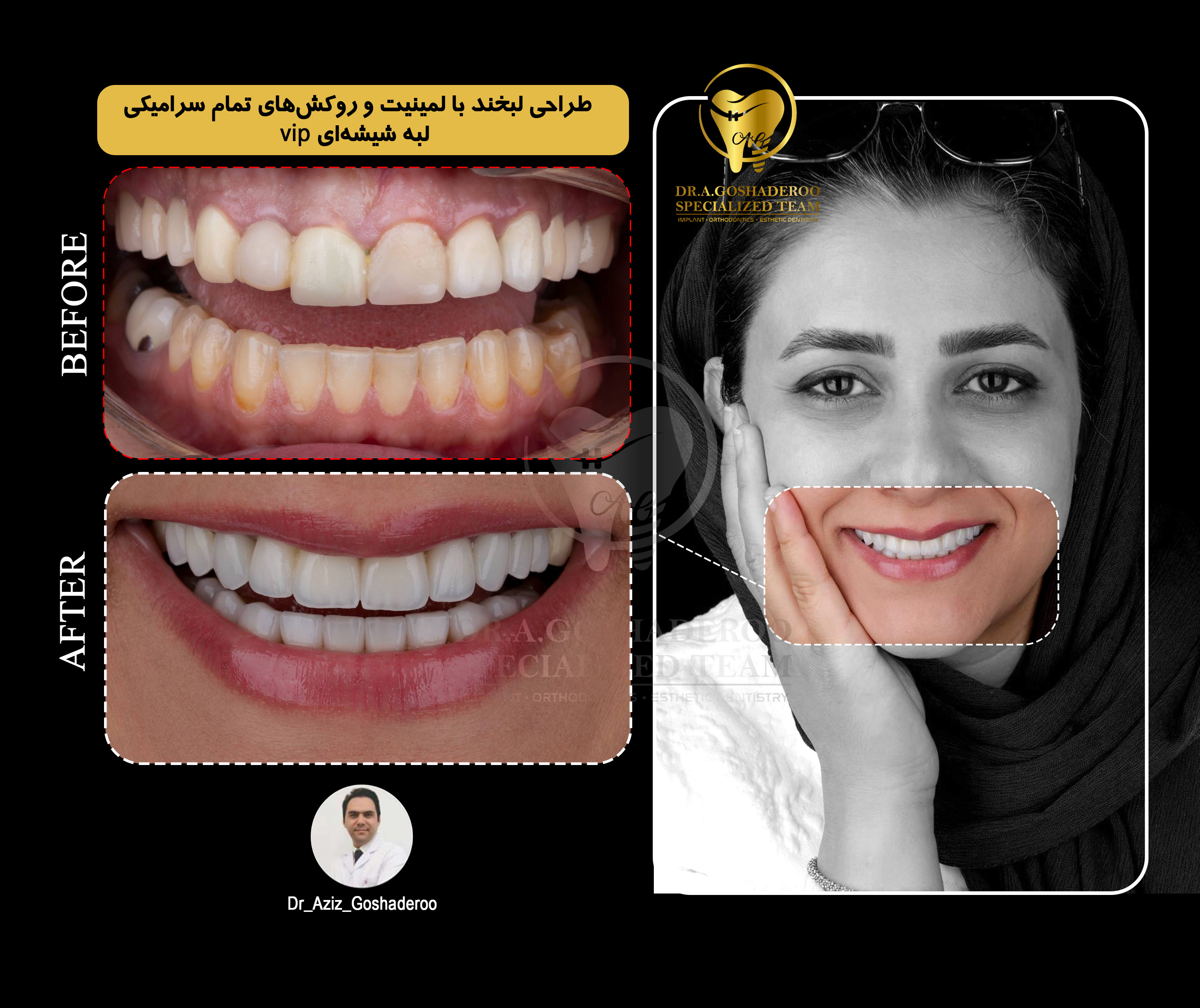 طراحی لبخند با لمینیت و روکش های تمام سرامیکی لبه شیشه ای vip