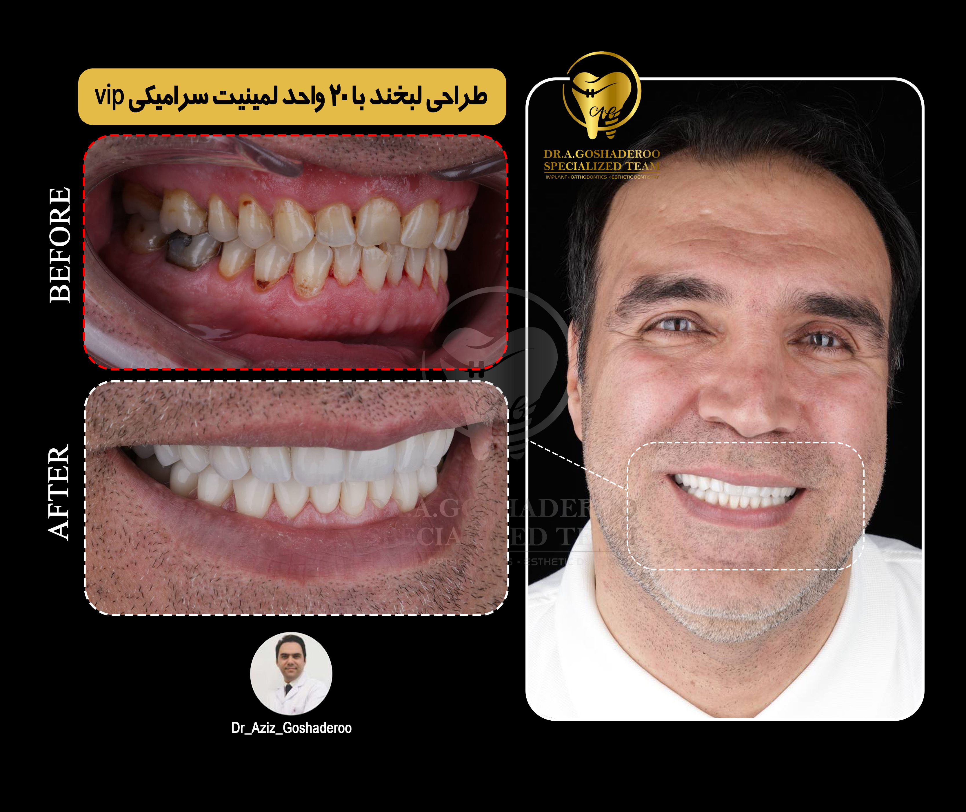 طراحی لبخند با 20 واحد لمینیت سرامیکی vip