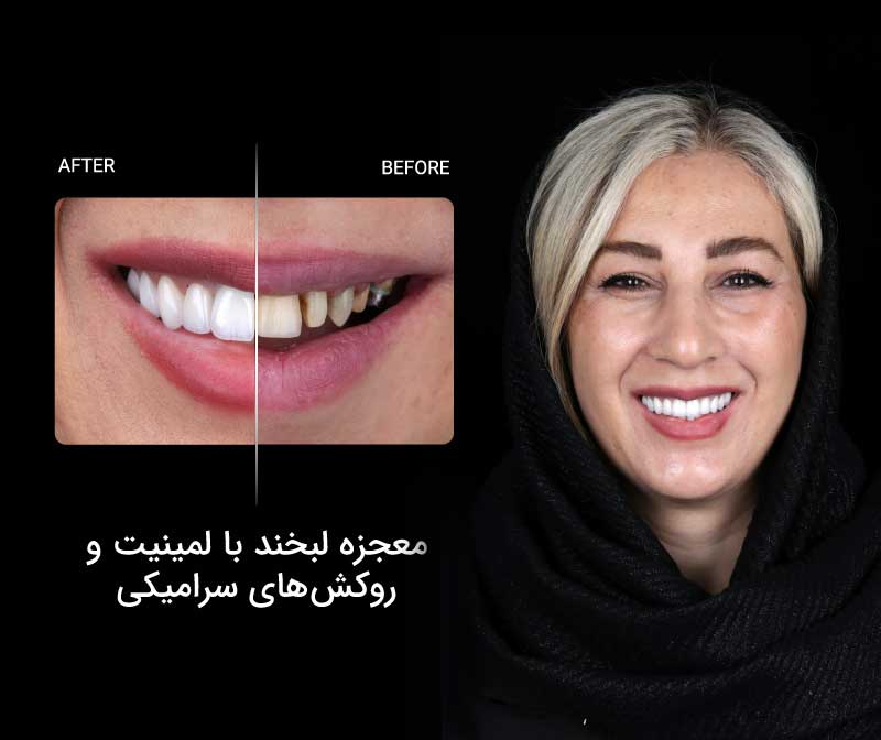 معجزه لبخند با لمینیت و روکش های سرامیکی