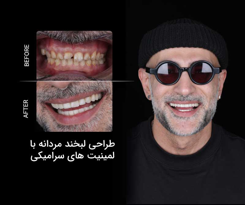 طراحی لبخند مردانه با لمینیت های سرامیکی