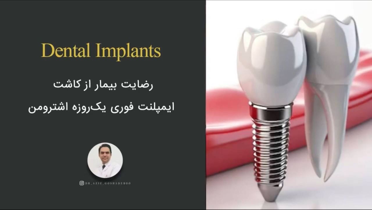 نمونه واقعی ایمپلنت فوری یک روزه اشترومن؛ کاشت ایمپلنت و روکش موقت در همان جلسه