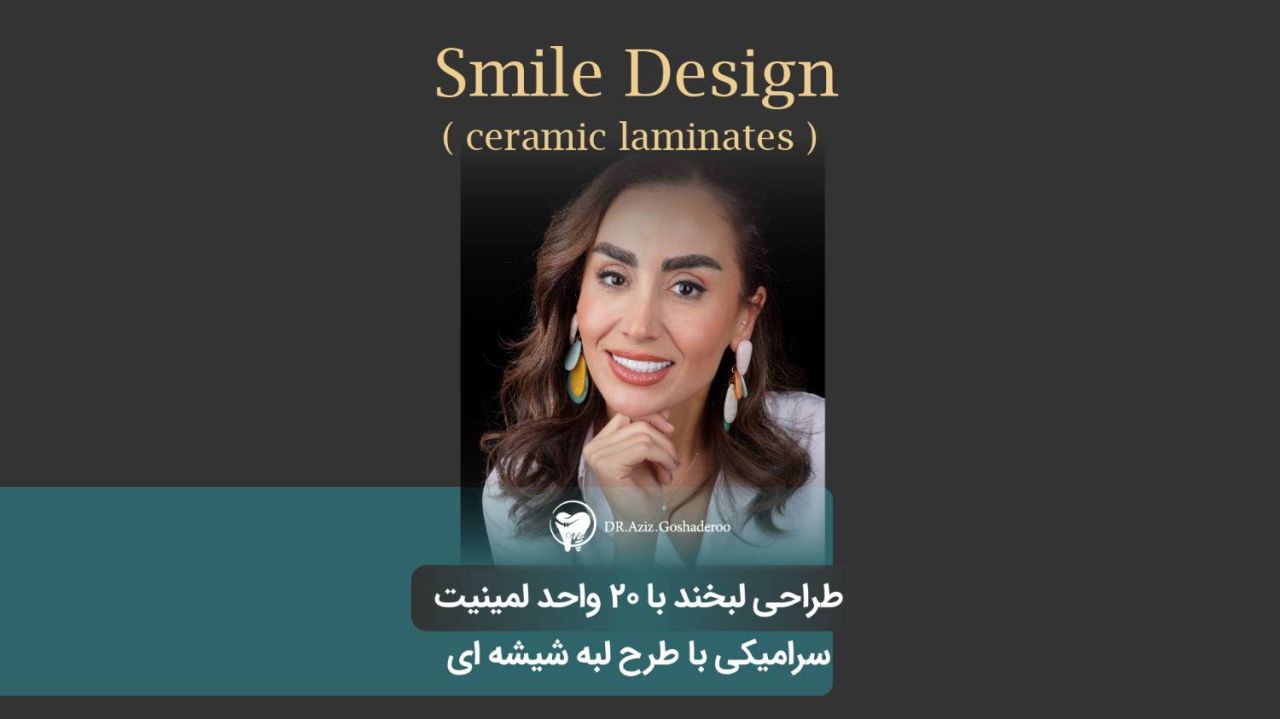 طراحی لبخند با 20 واحد لمینیت سرامیکی با طرح لبه شیشه ای