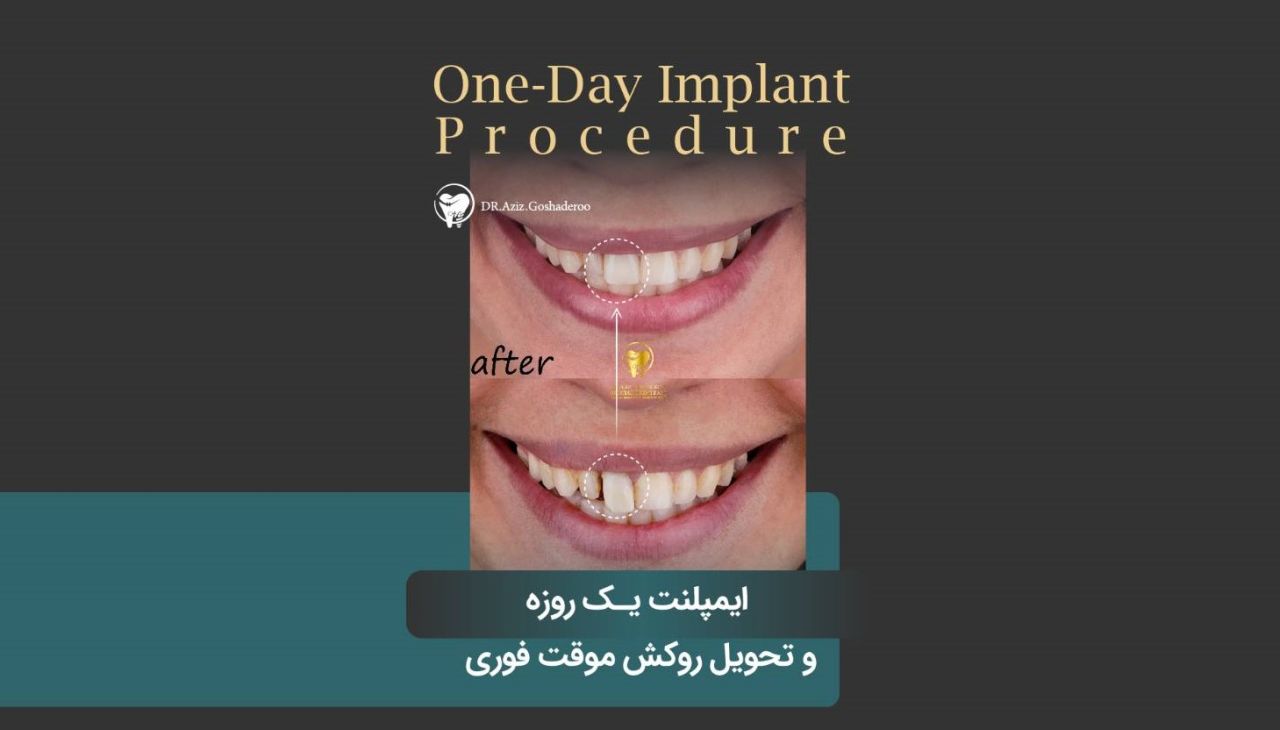 کاشت ایمپلنت یک روزه و تحویل روکش موقت فوری